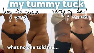 What I Wish I Knew Before Getting A Tummy Tuck full abdominoplasty [upl. by Leyes]