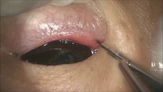 Punch punctoplasty for punctal stenosis by Dr Hunter Yuen [upl. by Annait]