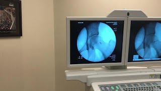 IntraArticular Injection of the Hip Under Fluoroscopic Guidance [upl. by Eseerahs495]