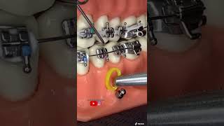 “Técnica para instalar microtornillos dentales ANCLAJE ESQUELÉTICO” [upl. by Puri174]