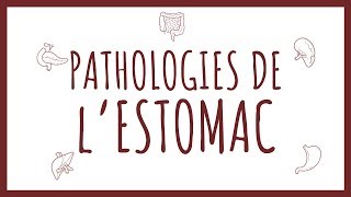 Sémiologie HGE  Pathologies Gastriques [upl. by Deach]