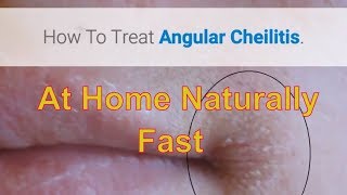 How To Treat Angular Cheilitis Naturally At Home Remedy That Works [upl. by Indira851]