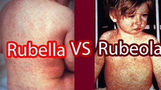 Rubella vs Rubeola Measles vs German Measles [upl. by Nerred506]