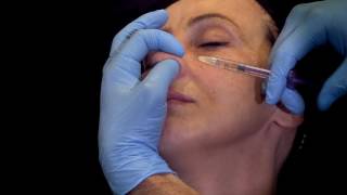 Injection acide hyaluronique pour remodeler le nez rhinoplastie naturelle médicale  Dr Raspaldo [upl. by Laved]