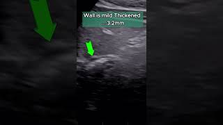 Acid Reflux  GERD  Ultrasound Diagnosis ultrasound gerd acidity acidreflux [upl. by Secilu792]