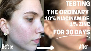 I Tried The Ordinary Niacinamide 10 Zinc 1 On My Acne Scars for 30 Days  HONEST REVIEW [upl. by Suhsoj]