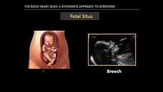 The Basic Fetal Heart Scan [upl. by Lipinski]