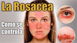 Cómo se CONTROLA la ROSÁCEA 🌋 ACNE ROSÁCEA Y RINOFIMA  Dra KATERYN PÉREZ WILLIS  DERMALASER KPW [upl. by Lisha936]