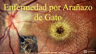 Enfermedad por Arañazo de Gato Neurorretinitis Infecciosa [upl. by Ube]