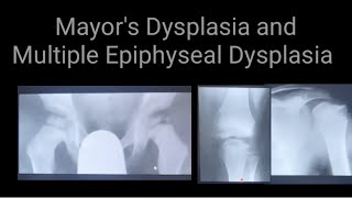 Mayors Dysplasia and Multiple Epiphyseal Dysplasia Radiology anx Xrays findings [upl. by Rhyner]