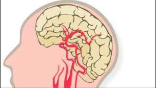 Trombolyse behandeling na een herseninfarct [upl. by Jenn207]