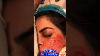 Micro Needling Treatment  Dermatologist  Rehman Skin Care Clinic  Islamabad  Blue Area skincare [upl. by Brote422]