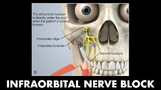 4A  Infraorbital Nerve Block Dr Simon Amir [upl. by Adnilem]