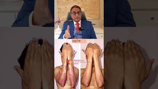 95 Plaque Psoriasis Recovery in 1 Month  NoSteroids Homeopathic Treatment [upl. by Porcia]