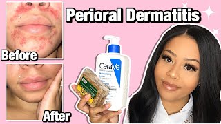 HOW I CLEARED MY PERIORAL DERMATITIS  Affordable Products [upl. by Lehcnom528]