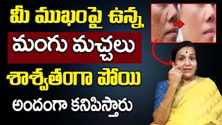 Dr L Umaa Venkatesh  Permanent Soloution For Pigmentation in Telugu  How to Remove Mangu Machalu [upl. by Llegna154]