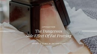 The Dangerous Side Effect Of Fat Freezing [upl. by Loring]