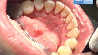 Periodontal treatment protocol [upl. by Horwath]