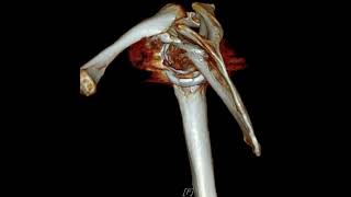 Acromion fracture after RTSA [upl. by Sukramed]