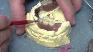 Denture Wrought Wire Clasp Repair  Discussion with Professor BatesMP4 [upl. by Vedette]