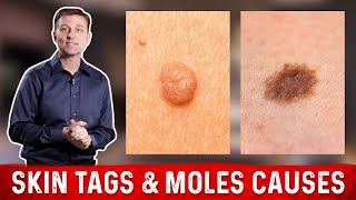 What Causes Skin Tags and Moles – Dr Berg [upl. by Sevik]