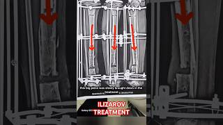 ILIZAROV TREATMENT ilizarovsurgery ytshorts [upl. by Nhtanhoj]