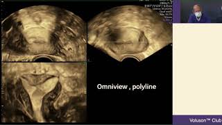 Les bases de léchographie de linfertilité [upl. by Hervey]