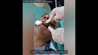 Leech Therapy in Mucormycosis by Dr Ram Shukla sir Gujrat [upl. by Anelehs]