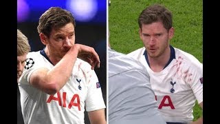 Vertonghen breaks his face  Tottenham Ajax 01 [upl. by Kenny]