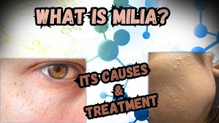 What Is Milia What Are Its Causes And Its Treatment [upl. by Corotto]