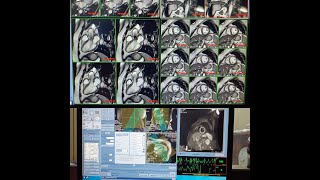 MRI Cardiac for chambers viability in GE HDXT 15 T [upl. by Addie176]