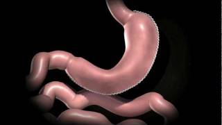 Laparoscopic Sleeve Gastrectomy Animation [upl. by Glenna]