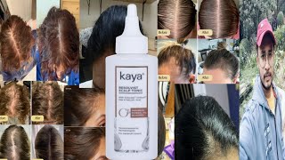 Kaya Resolvist Scalp Tonic  Honest Review [upl. by Daegal]