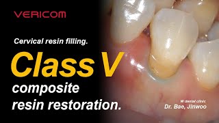 Cervical resin filling Class V Composite resin restoration [upl. by Jeannette]