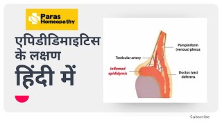 Epididymitis Symptoms Causes and Treatment  Epididymitis Homeopathy Medicine  Paras Homeopathy [upl. by Deedahs]