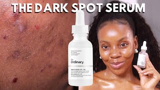 ALPHA ARBUTIN THE ORDINARY THE TRUTH ABOUT THE ORDINARY ALPHA ARBUTIN HOW TO GET RID OF DARK SPOT [upl. by Akimas106]