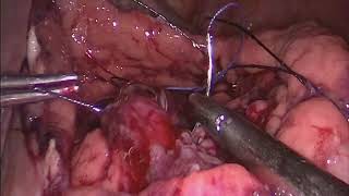 Laparoscopic Cysto Gastrostomy for Pseudocyst Pancreas [upl. by Kenward664]