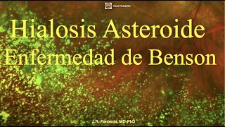 Hialosis Asteroide Enfermedad de Benson Scintillatio Nívea o Scintillatio Albescens [upl. by Ahseei371]