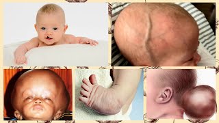 10 COMMON BIRTH DEFECTS  GENETIC DEFECTS IN PREGNANCY  WHAT ARE BIRTH DEFECTS [upl. by Amandie945]