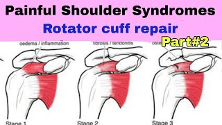 lec 15 Rotator cuff repair exercise guidelines and precautions [upl. by Eiramave]