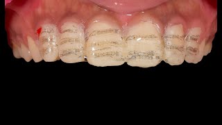 Step by Step Veneer Preparation And Cementation  EMAX Porcelain Veneer  Clinical case [upl. by Livingstone]