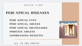 DISEASES OF PERIAPICAL TISSUE [upl. by Asilrahc]