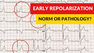 Early repolarization syndrome and pattern Norm or pathology [upl. by Zuzana]