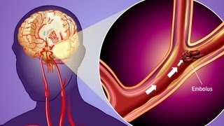 Stroke Prevention amp Transient Ischemic Attack TIA [upl. by Nahama]