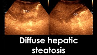 Fatty Liver  Diffuse hepatic steatosis  Liver Ultrasonogram [upl. by Enileve991]