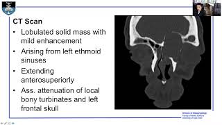 Rhinology Case Mucocele [upl. by Ellenor]