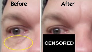 How Use Trichloroacetic Acid on Xanthelasma Spots Around Eyes at Home WARNING My BAD Experience TCA [upl. by Ecydnarb]