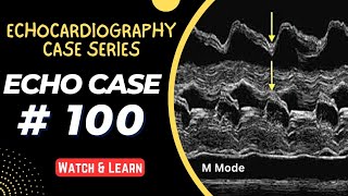 ECHO CASE 100  Echocardiography for Beginners  M Mode Echocardiogram [upl. by Timmons52]