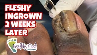 Fleshy Ingrown Toenail Removal 2 Weeks Later [upl. by Antonie]