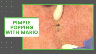 ASMR Remove Big Acne amp Infected Back  Deep Cleaning Animation [upl. by Ainevuol]